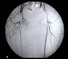 Angiography