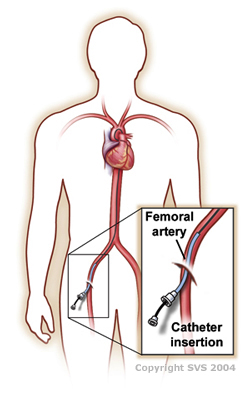 Diseased Artery diagram