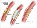 Balloon Angioplasty