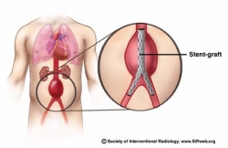 Stent Graft diagram