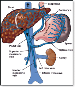 Liver Cirrhosis Diagram