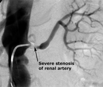 Severe Stenosis of renal artery