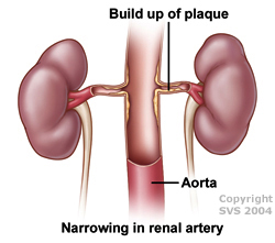 Build up of plaque, narrowing in renal artery