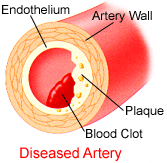 Diseased Artery diagram