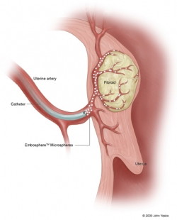 Infusion of particles into fibroid