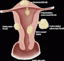 Different types of fibroids