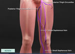 Vein Disease