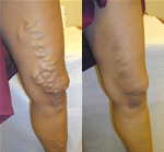 Vein Disease